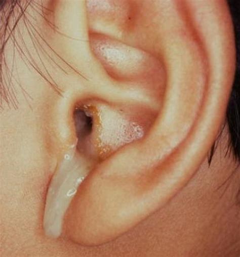 csf leaking from ears|CSF Otorrhea: Practice Essentials, Epidemiology, Etiology